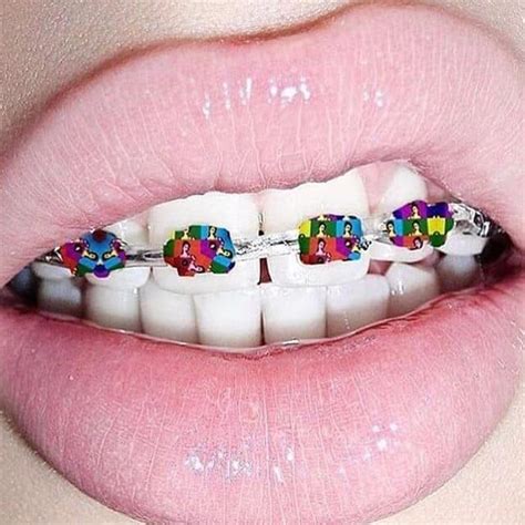 Pin By Trinh Nguyen On Its Cool To Have Braces Dental Braces Lip Art Cute Braces Colors