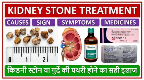 Kidney Stone Treatment Causes Symptoms Medicines किडनी स्टोन या