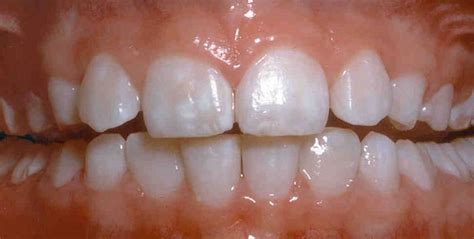 What Is Dental Fluorosis And How Is It Treated Your Dental Health