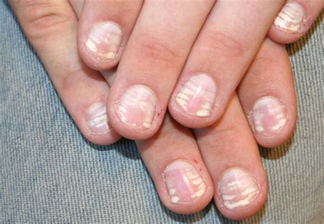 Qué son las manchas blancas en las uñas cómo tratarlas