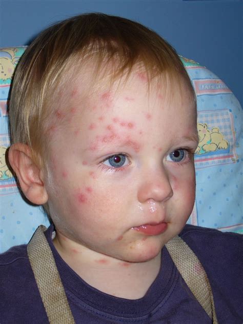 Chicken Pox Symptoms In Kids Pictures 27 Photos And Images