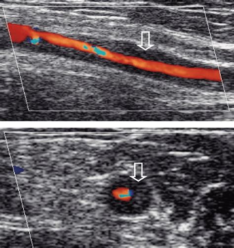 Color Doppler Ultrasound In Large Vessel Giant Cell Arteritis A