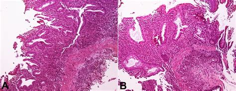Photomicrographs Of The Colonic Mucosal Biopsy Indicating Ulcerative