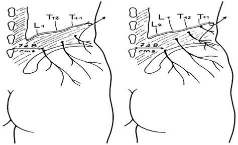 Entrapment Neuropathy Of The Medial Superior Cluneal Nerve Spine