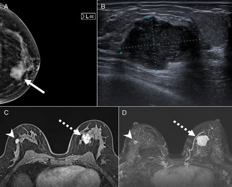 Complex Fibroadenoma Mimicking Breast Cancer On 68ga Fapi 04