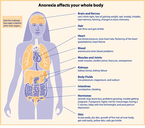 Magersucht Anorexia Nervosa Causes Symptoms Treatment Magersucht