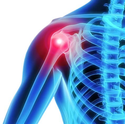 Shoulder Inflammation The Orthopedic And Sports Medicine Institute In