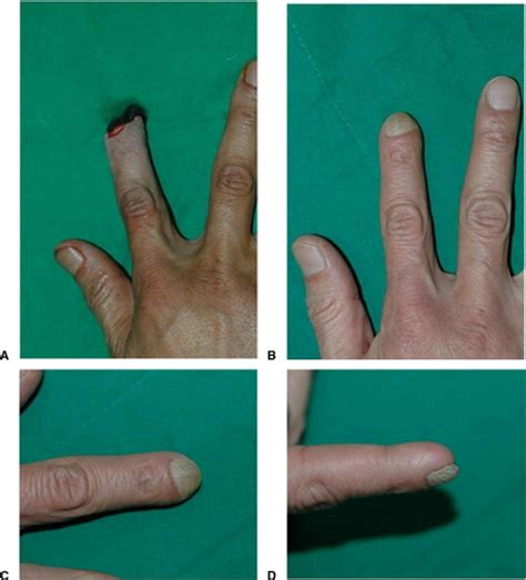 Fingertip Reconstruction With Simultaneous Flaps And Nail Bed Grafts