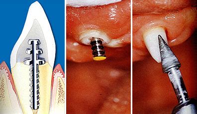 Kronen aus metall (auch vollgusskronen genannt) sind sehr stabil und dementsprechend lange haltbar. Nach Wurzelbehandlung fällt der Zahn auseinander. Was ...