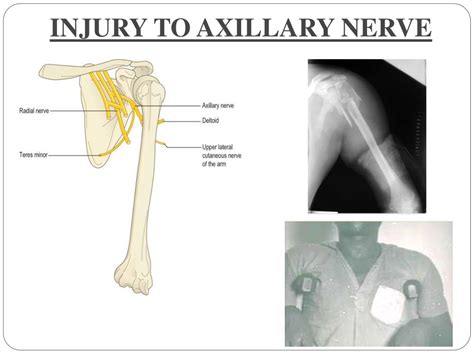 Ppt Nerves Of Upper Limb And Their Lesions Powerpoint Presentation Id