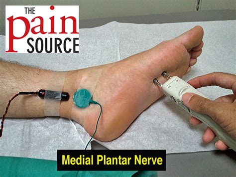 Medial Plantar Nerve Entrapment Symptoms