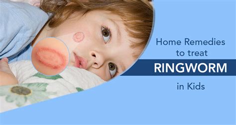 What Home Remedy Will Kills Ringworm On Dogs