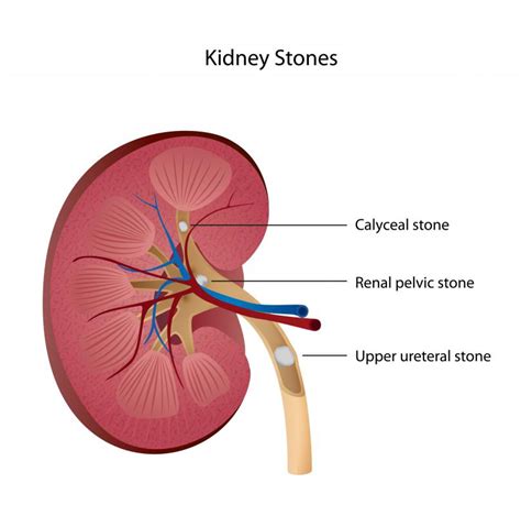 What Are Urinary Tract Stones With Pictures