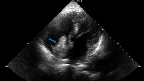Tte Apical Four Chamber View Showing A Large Mass In The Right Atrium