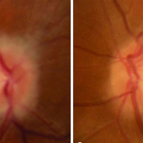 Color Fundus Photographs Of The Right Eye A And The Left Eye B
