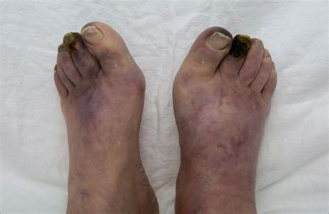 Bilateral Foot Gangrene Cardiology Jama Oncology Jama Network