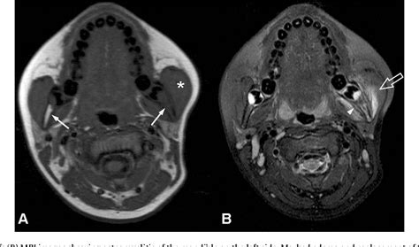 Figure 1 From Mandibular Osteomyelitis In Children Mimicking Juvenile