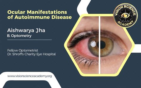 Ocular Manifestations Of Autoimmune Disease Vision Science Academy