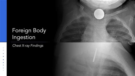 Foreign Body Ingestion Chest Xray Youtube