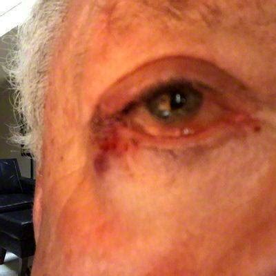 How long is the recovery from the recovery time for cataract surgery is short. Recovery After Eyelid Surgery » Eyelid Surgery: Cost ...