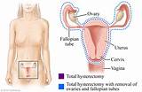 How Long Is The Recovery For Hysterectomy Images