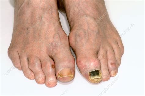 Gout In The Toes Stock Image C0142449 Science Photo Library