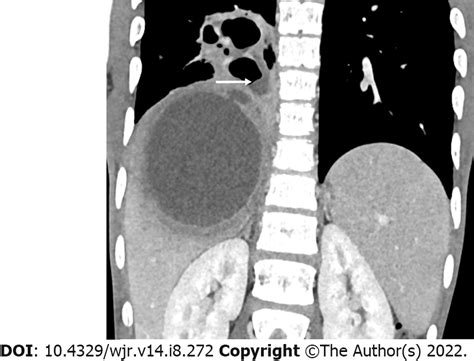 Amebic Liver Abscess Clinico Radiological Findings And Interventional