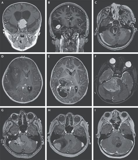 Brain Tumors In Children Nejm