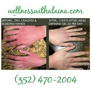 Are You Tired Of Having Dry Cracked Bleeding Hands Our Itworks