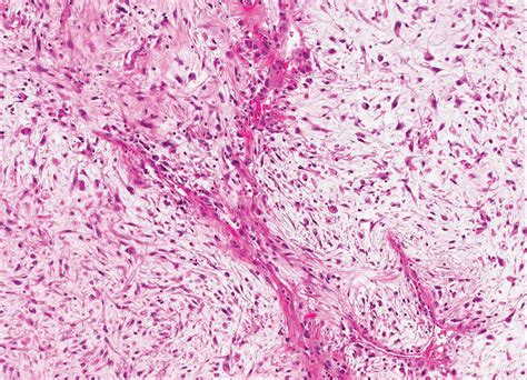 Myxoid Cutaneous Tumors A Review Zou 2016 Journal Of Cutaneous