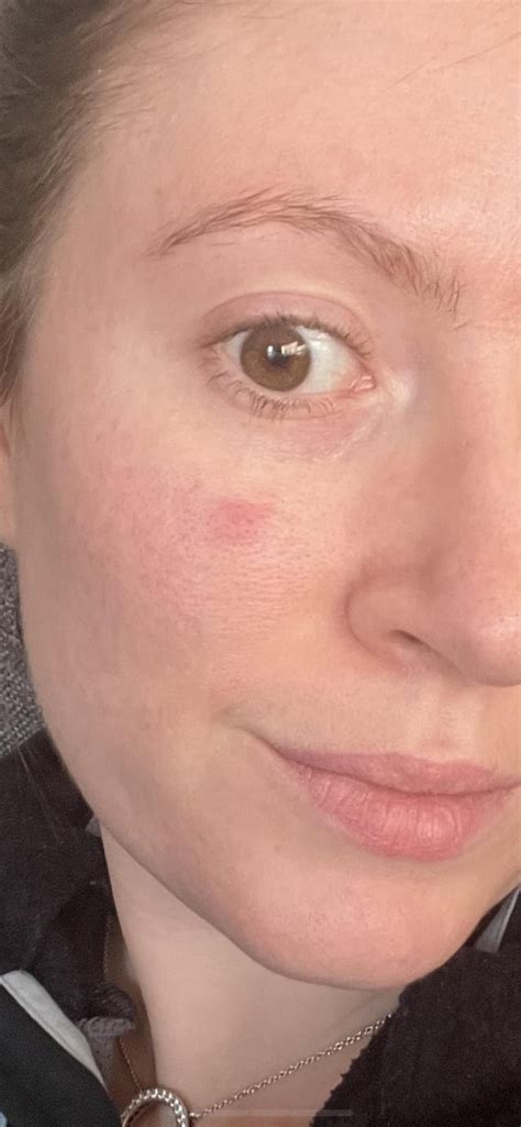 Red Spot On Face Not Going Away Any Recommendations Or Advice R