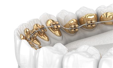 The Benefits Of Incognito Braces Wilkinson Orthodontics Gold Coast