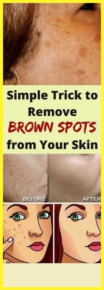 Remove Blackheads With One Simple And Effective Trick Brown Spots Removal Brown Spots On Face