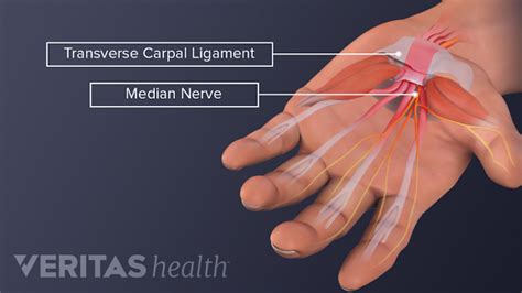 Carpal Tunnel Surgery What To Expect