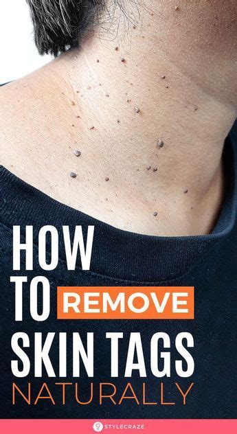 12 Home Remedies To Remove Skin Tags Naturally Artofit
