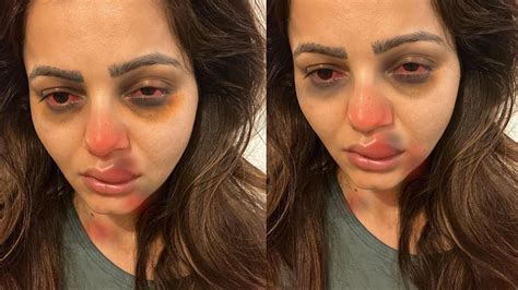 Rubina Dilaik Crying After Her Lip Surgery Gone Wrong Looks