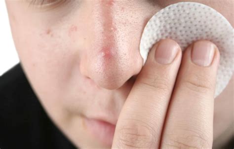 How To Prevent Pimples On Nose According To Dermatologists