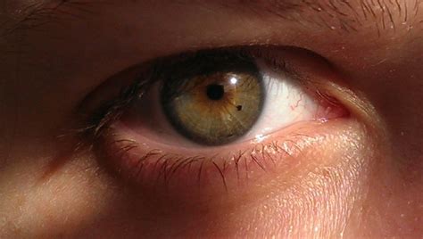 Eye Freckles Choroidal Nevus Babycenter