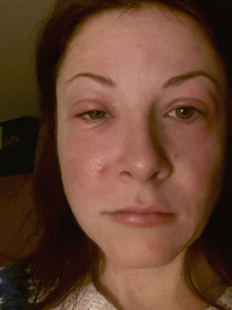 The Fear Of The Swollen Face An Allergic Reaction To What Whoopee Gluten Free