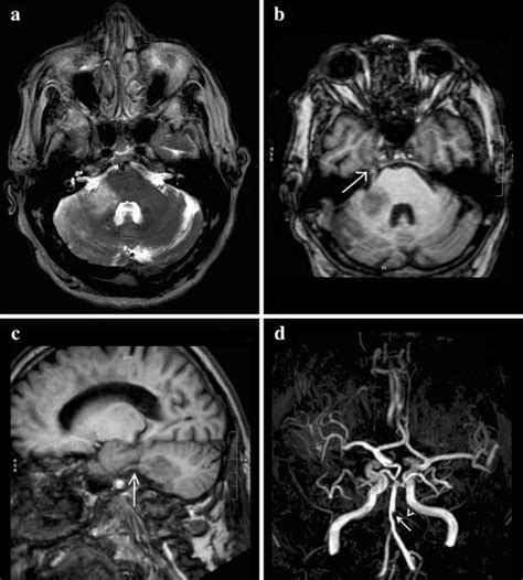 Infarction In The Right Cerebellar Peduncle Extending Toward The