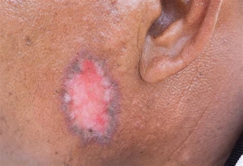 Psoriasis Vs Ringworm Differences In Symptoms Causes And Treatments