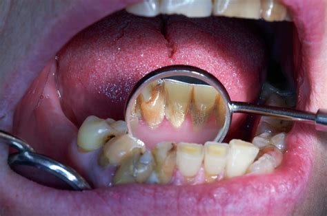 Examining Decayed Teeth Photograph By Dr Armen Taranyan Science Photo