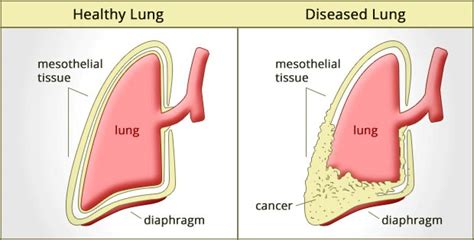 What Are The Different Types Of Mesothelioma Cancer Ganvwale