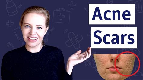 Check spelling or type a new query. How To Get Rid Of Acne Scars: 11 Remedies That Work