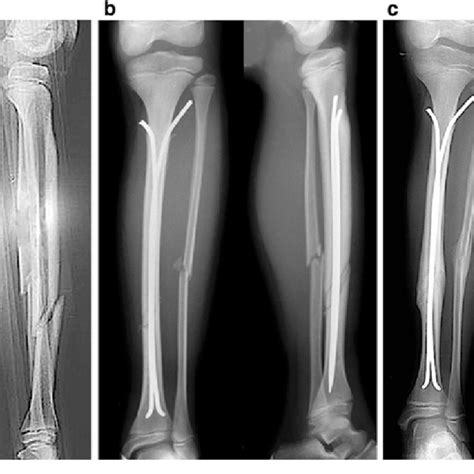 Tibia Fracture Treated By Esin A Displaced Shaft Fracture Of Fibula