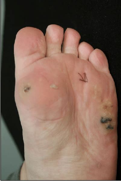 A Solitary Tender Subcutaneous Nodule Arrow And Multiple Warts On The