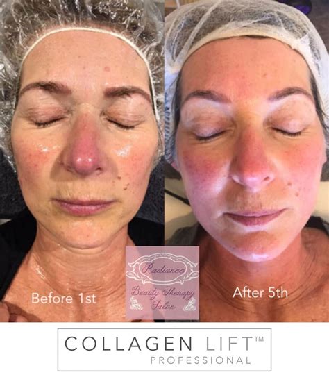 Collagen Lift Before And After Images