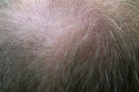 vitamin deficiency causes hair loss a guide — eating enlightenment