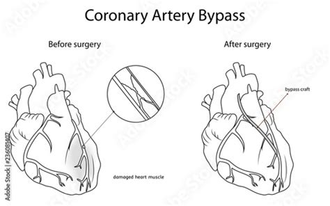 Coronary Artery Bypass Medical Flat Outline Vector Illustration