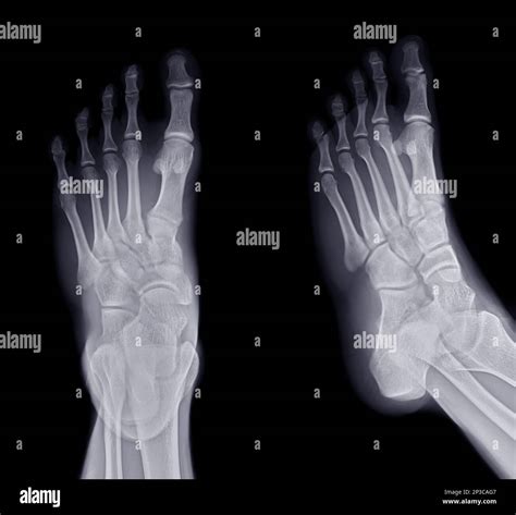 Foot X Ray Image Ap And Oblique View Isolated On Black Background Stock